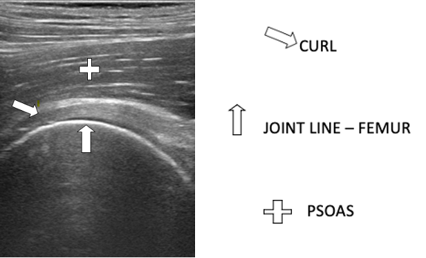 Intra Articular Ultrasound Guided Injections Description Of The